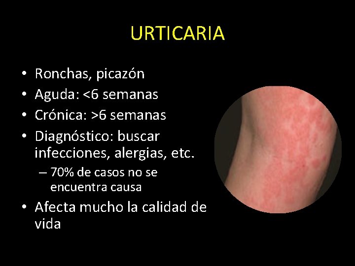 URTICARIA • • Ronchas, picazón Aguda: <6 semanas Crónica: >6 semanas Diagnóstico: buscar infecciones,