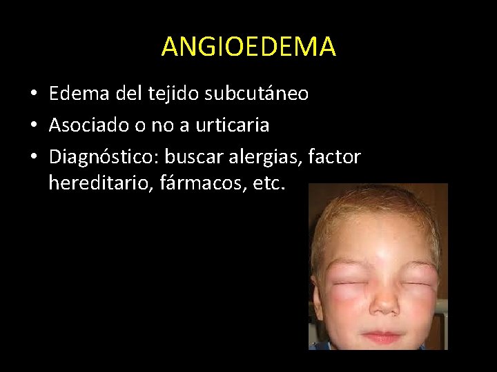 ANGIOEDEMA • Edema del tejido subcutáneo • Asociado o no a urticaria • Diagnóstico: