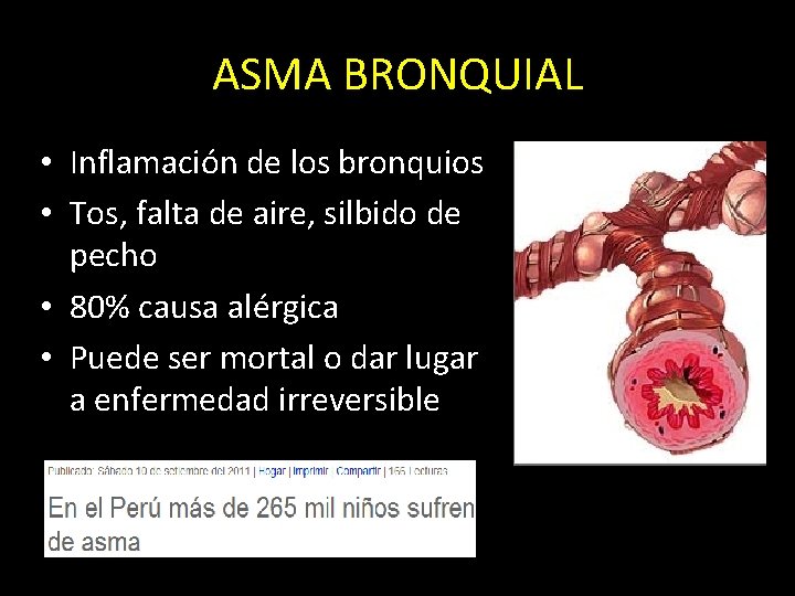 ASMA BRONQUIAL • Inflamación de los bronquios • Tos, falta de aire, silbido de