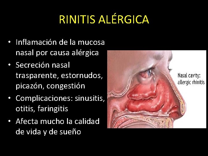RINITIS ALÉRGICA • Inflamación de la mucosa nasal por causa alérgica • Secreción nasal