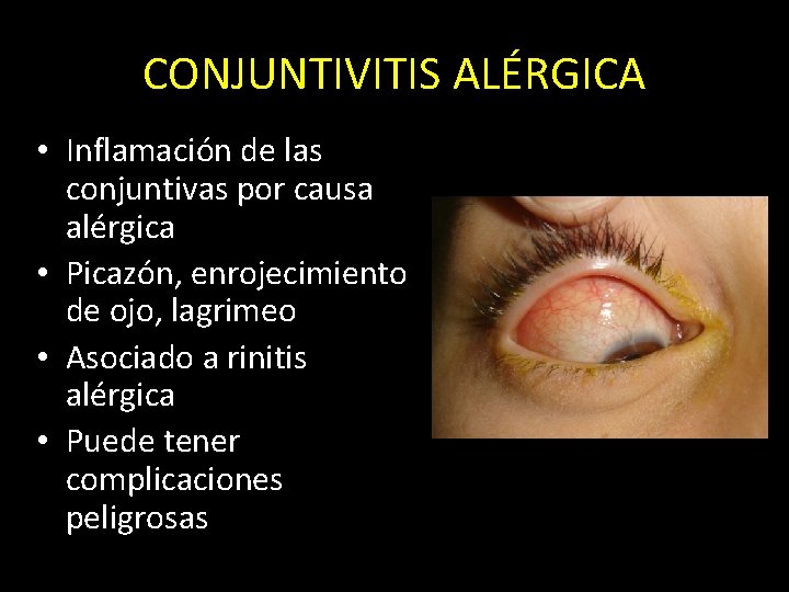 CONJUNTIVITIS ALÉRGICA • Inflamación de las conjuntivas por causa alérgica • Picazón, enrojecimiento de