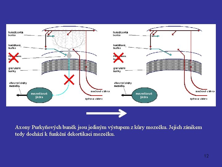 Axony Purkyňových buněk jsou jediným výstupem z kůry mozečku. Jejich zánikem tedy dochází k
