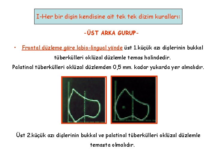 I-Her bir dişin kendisine ait tek dizim kuralları: -ÜST ARKA GURUP- • Frontal düzleme I-Her bir dişin kendisine ait tek dizim kuralları: -ÜST ARKA GURUP- • Frontal düzleme