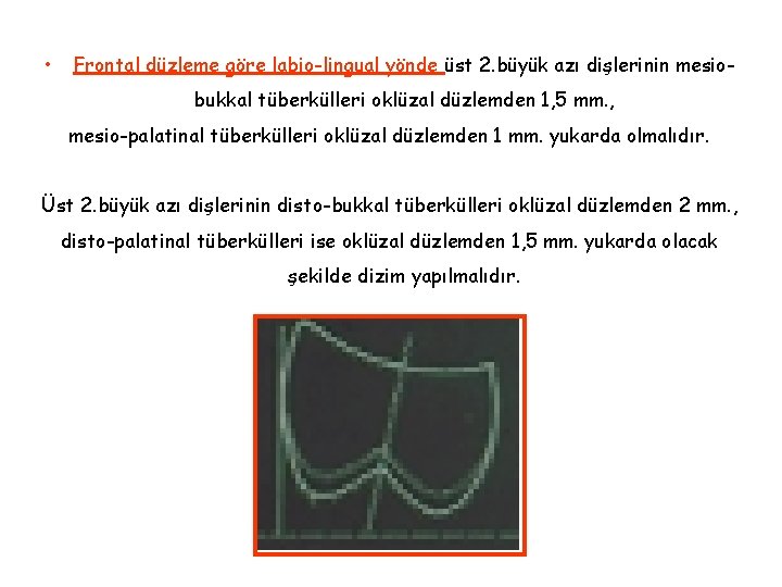 • Frontal düzleme göre labio-lingual yönde üst 2. büyük azı dişlerinin mesiobukkal tüberkülleri • Frontal düzleme göre labio-lingual yönde üst 2. büyük azı dişlerinin mesiobukkal tüberkülleri