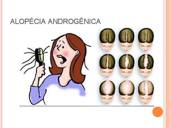 ALOPÉCIA ANDROGÊNICA 