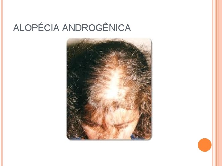 ALOPÉCIA ANDROGÊNICA 