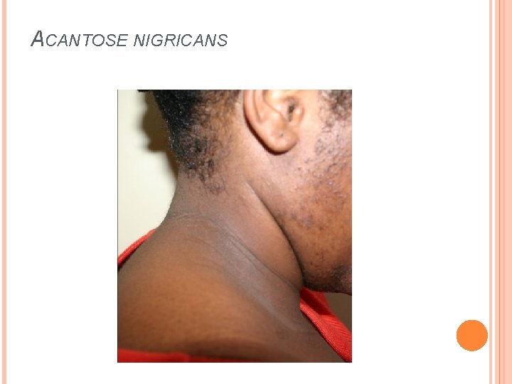 ACANTOSE NIGRICANS 