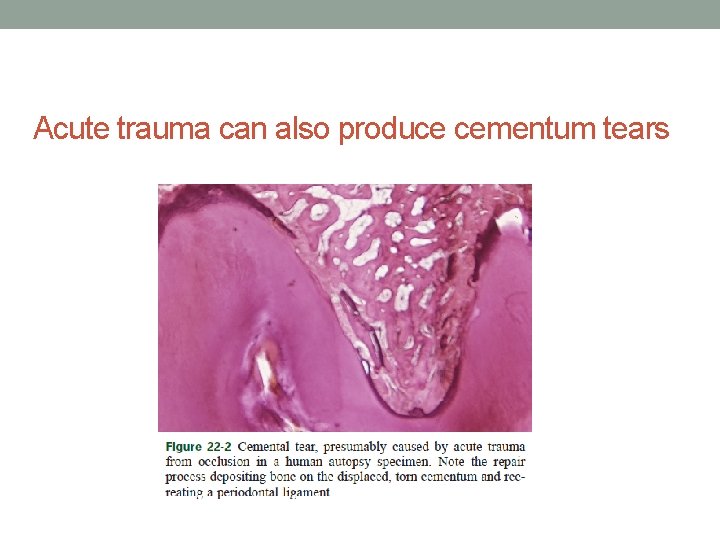 Acute trauma can also produce cementum tears 