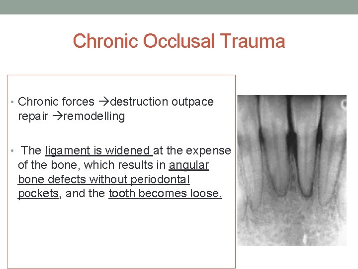 Chronic Occlusal Trauma • Chronic forces destruction outpace repair remodelling • The ligament is