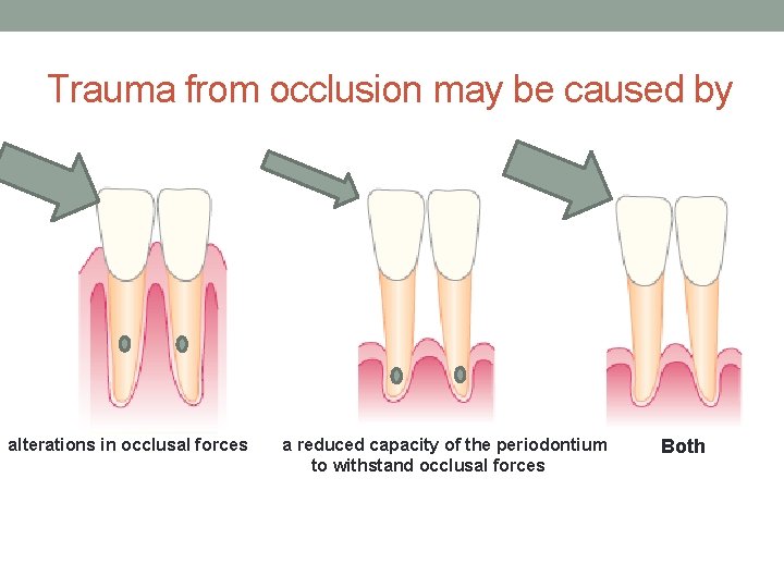 Trauma from occlusion may be caused by alterations in occlusal forces a reduced capacity