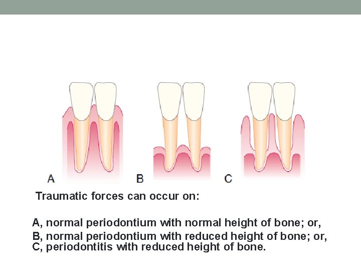 Traumatic forces can occur on: A, normal periodontium with normal height of bone; or,