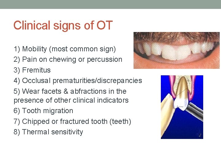 Clinical signs of OT 1) Mobility (most common sign) 2) Pain on chewing or