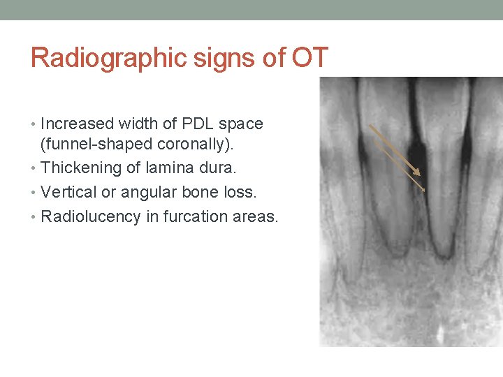 Radiographic signs of OT • Increased width of PDL space (funnel-shaped coronally). • Thickening