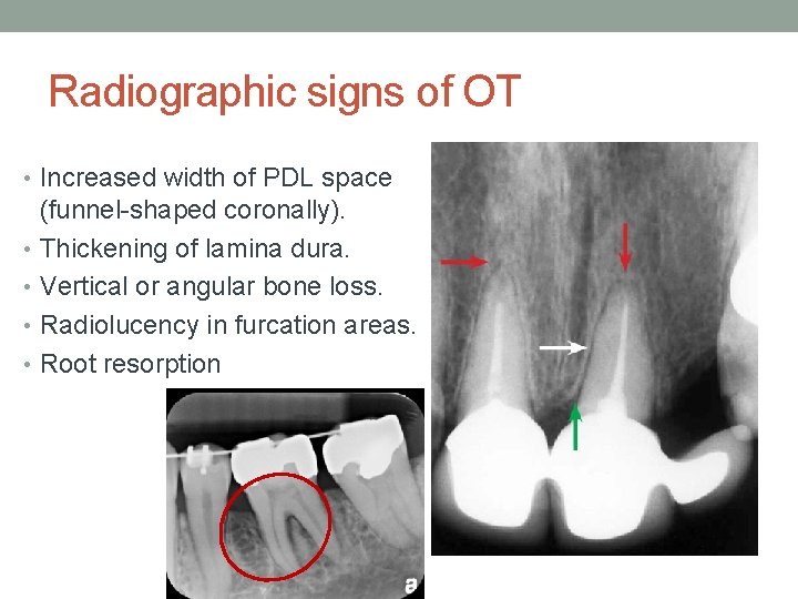 Radiographic signs of OT • Increased width of PDL space (funnel-shaped coronally). • Thickening