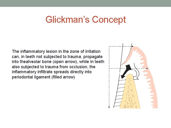 Glickman’s Concept The inflammatory lesion in the zone of irritation can, in teeth not