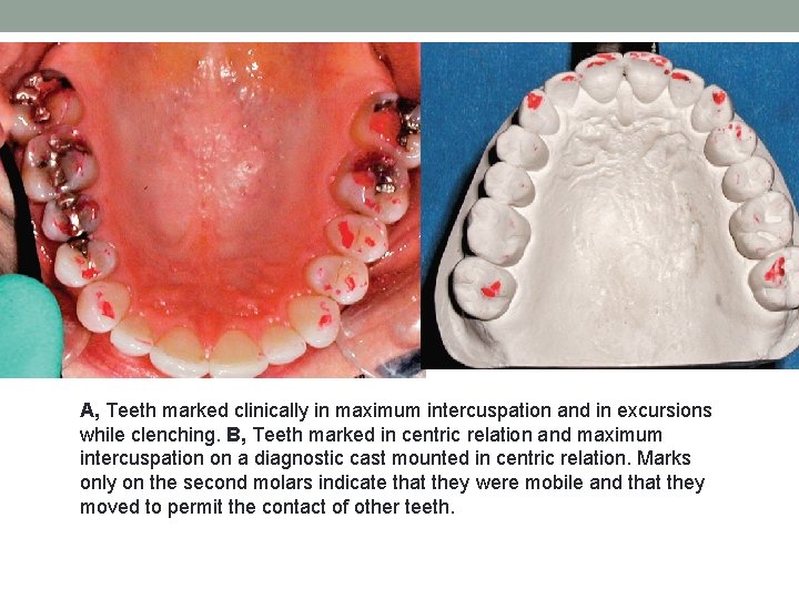 A, Teeth marked clinically in maximum intercuspation and in excursions while clenching. B, Teeth