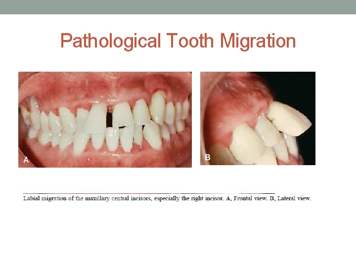 Pathological Tooth Migration 