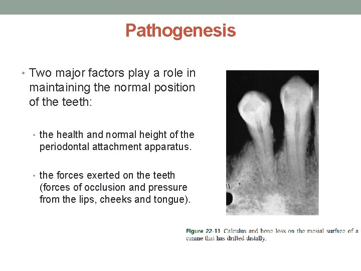 Pathogenesis • Two major factors play a role in maintaining the normal position of