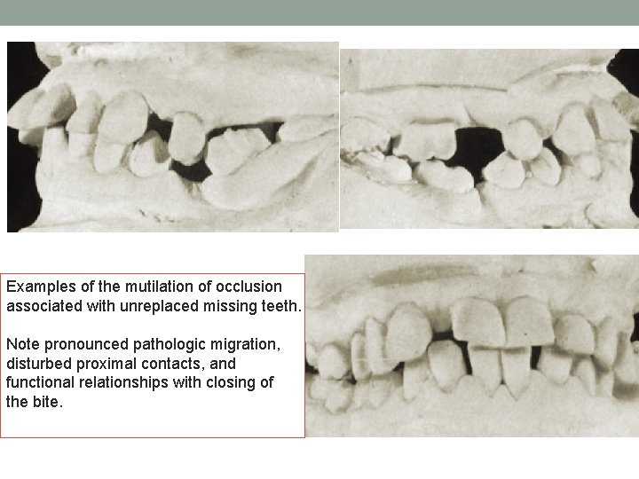Examples of the mutilation of occlusion associated with unreplaced missing teeth. Note pronounced pathologic