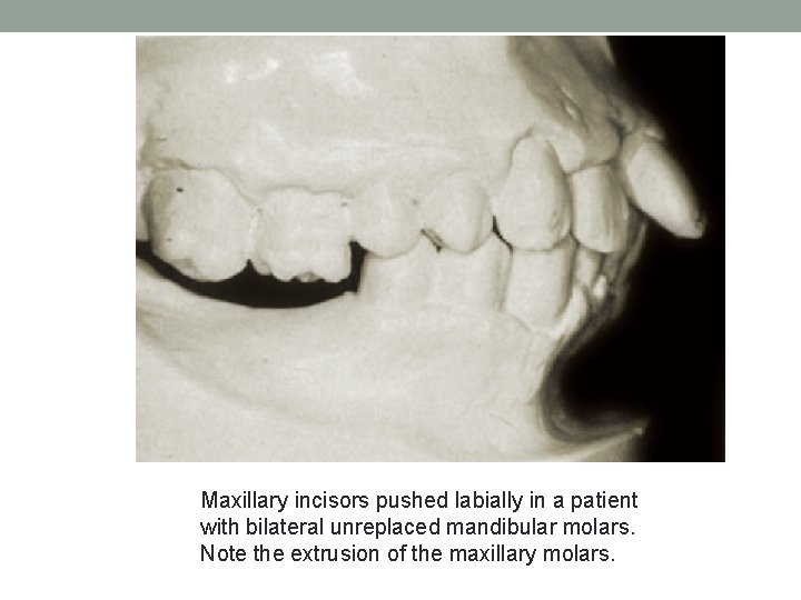 Maxillary incisors pushed labially in a patient with bilateral unreplaced mandibular molars. Note the
