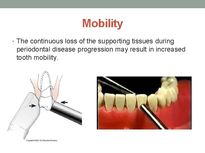 Mobility • The continuous loss of the supporting tissues during periodontal disease progression may