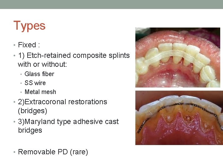 Types • Fixed : • 1) Etch-retained composite splints with or without: • Glass