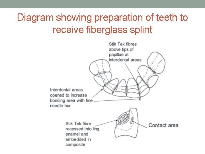 Diagram showing preparation of teeth to receive fiberglass splint 