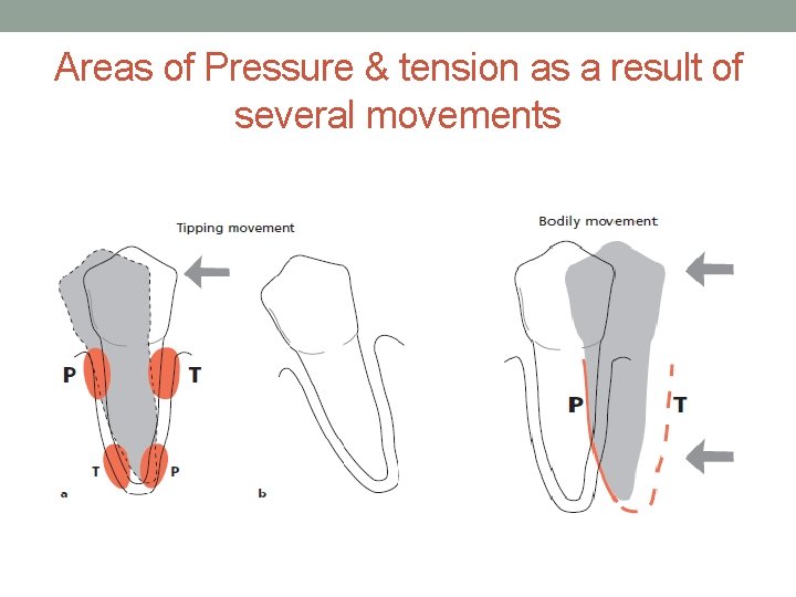 Areas of Pressure & tension as a result of several movements 