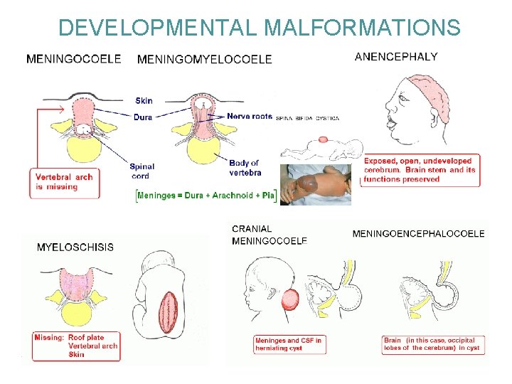 DEVELOPMENTAL MALFORMATIONS 