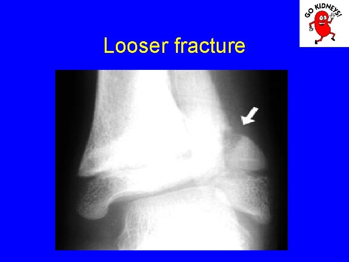 Looser fracture 