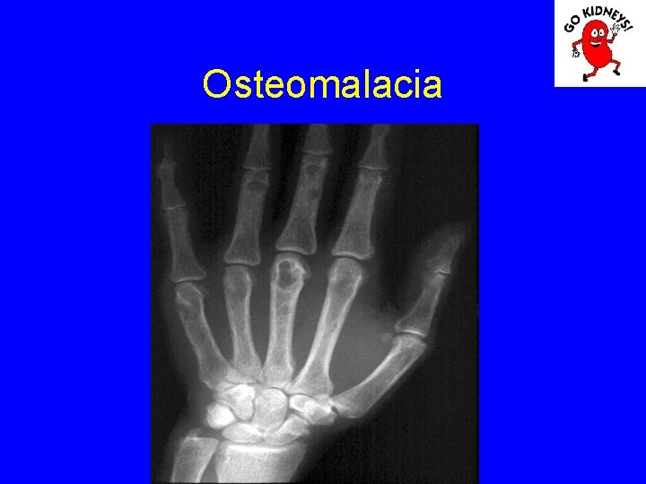 Osteomalacia 