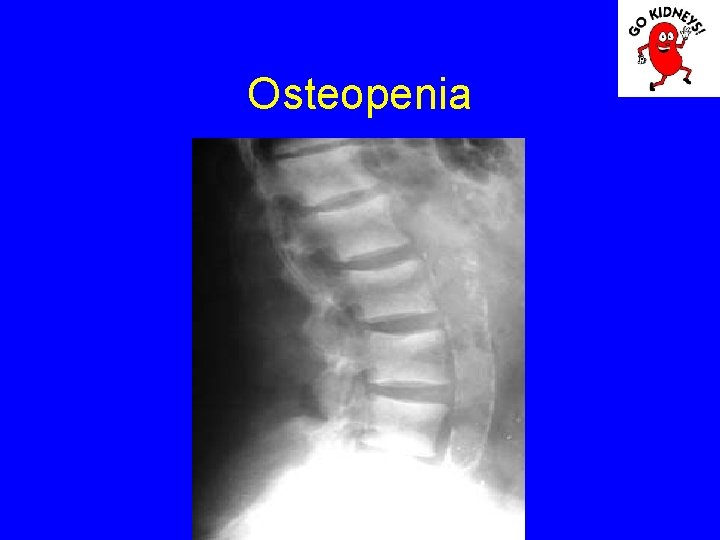 Osteopenia 