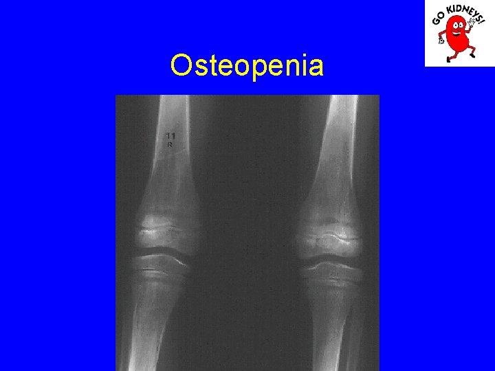 Osteopenia 