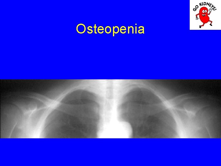 Osteopenia 