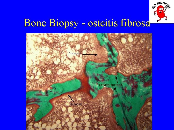 Bone Biopsy - osteitis fibrosa 