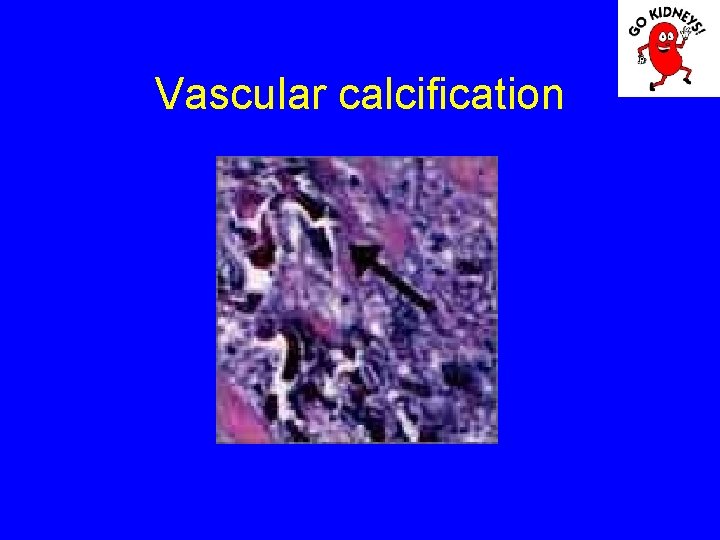 Vascular calcification 