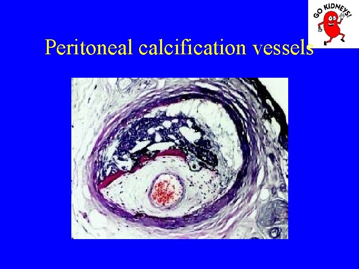 Peritoneal calcification vessels 