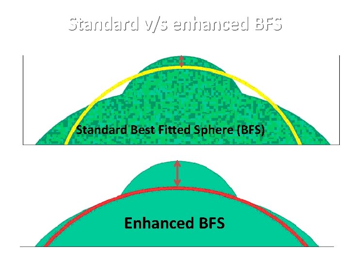 Standard v/s enhanced BFS Standard Best Fitted Sphere (BFS) Enhanced BFS 