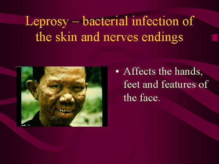 Leprosy – bacterial infection of the skin and nerves endings • Affects the hands,