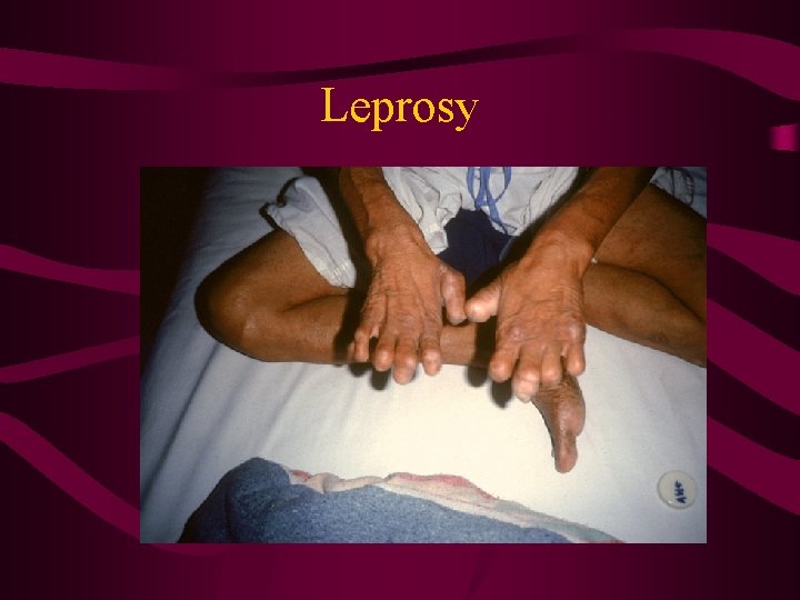 Leprosy 