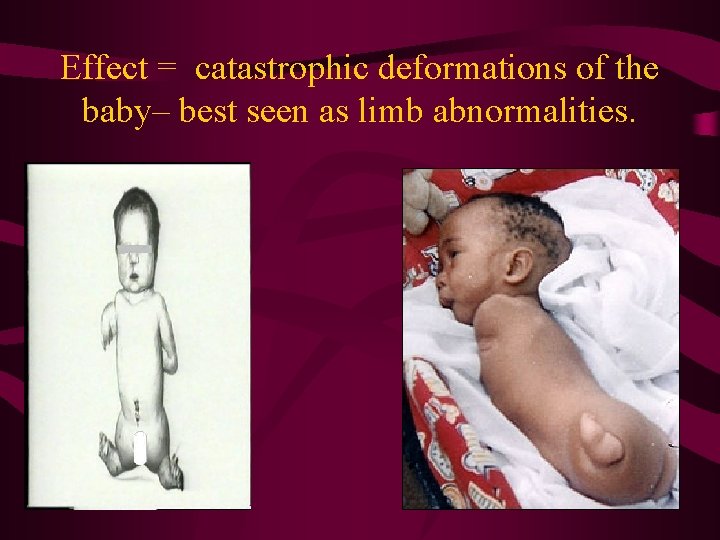 Effect = catastrophic deformations of the baby– best seen as limb abnormalities. 