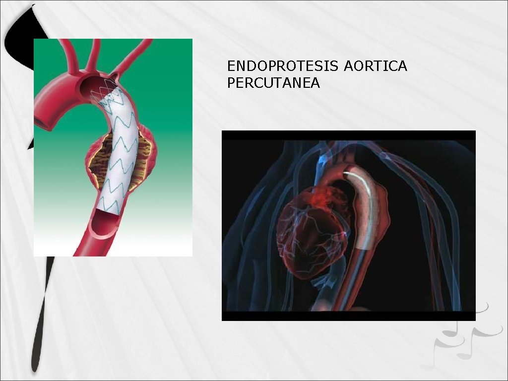 ENDOPROTESIS AORTICA PERCUTANEA 