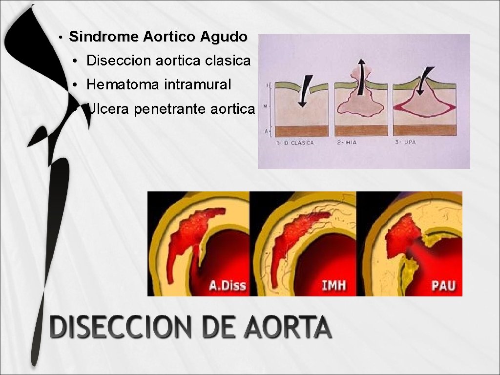  • Sindrome Aortico Agudo • Diseccion aortica clasica • Hematoma intramural • Ulcera