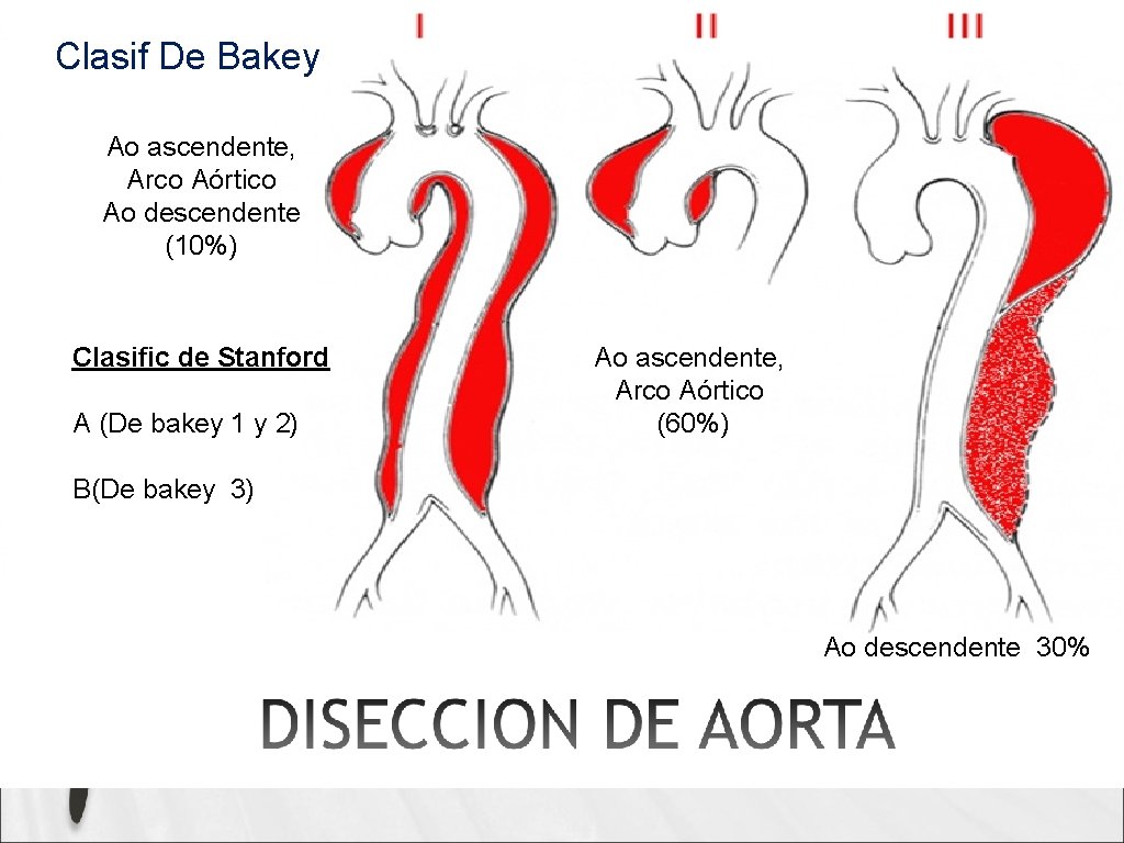 Clasif De Bakey Ao ascendente, Arco Aórtico Ao descendente (10%) Clasific de Stanford A