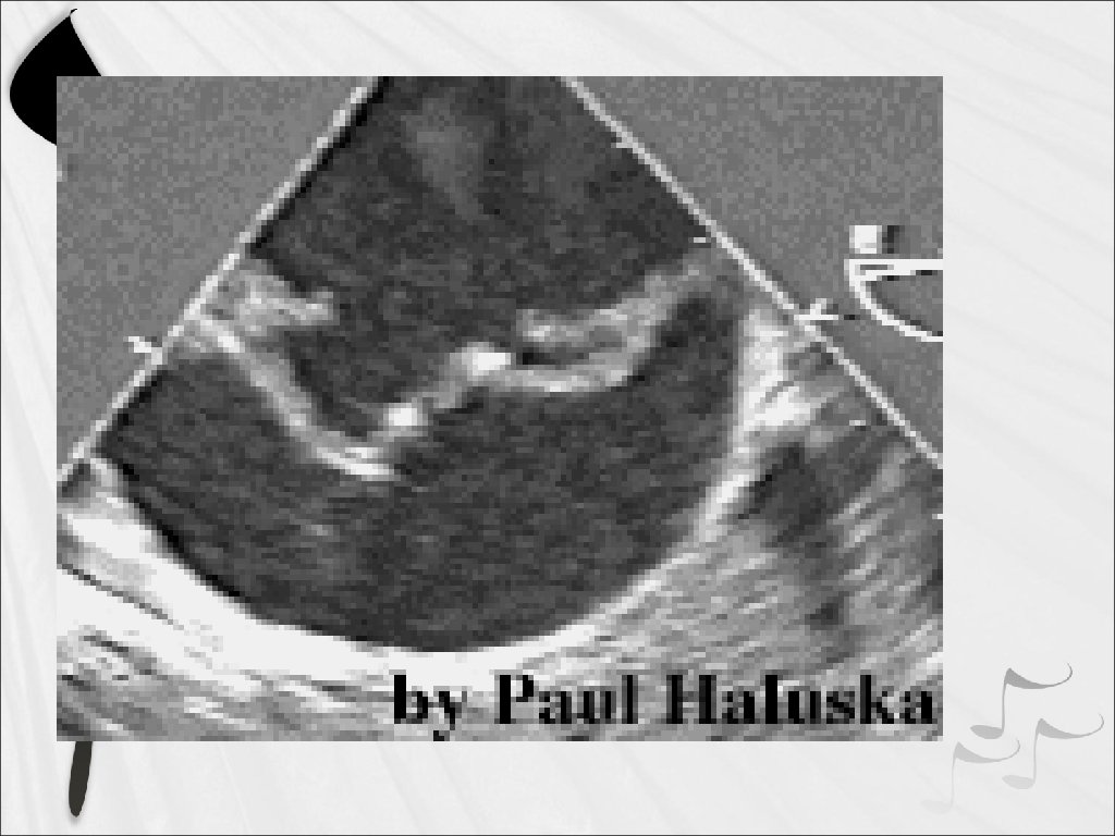 DISECCION AORTICA 