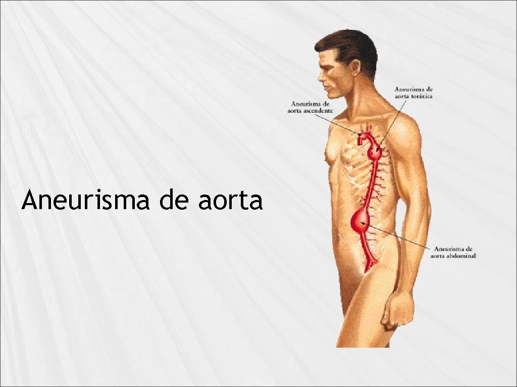 Aneurisma de aorta 