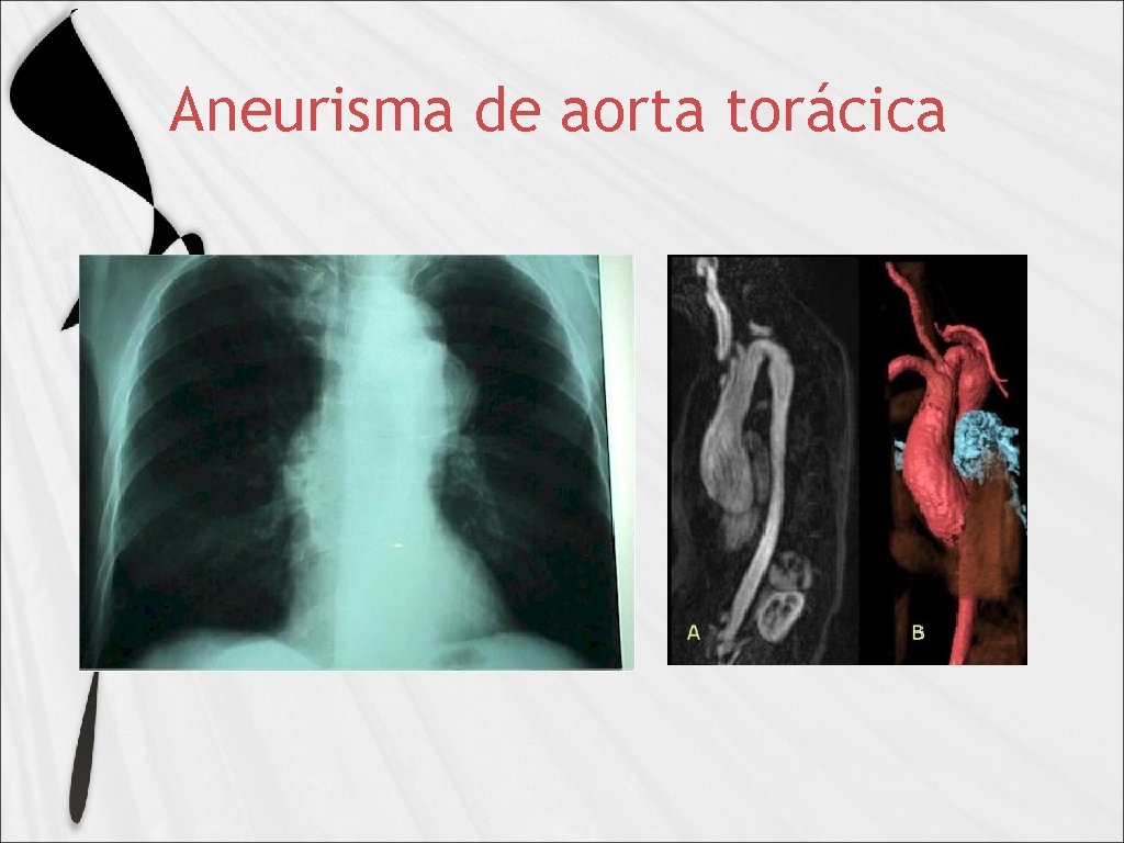 Aneurisma de aorta torácica 