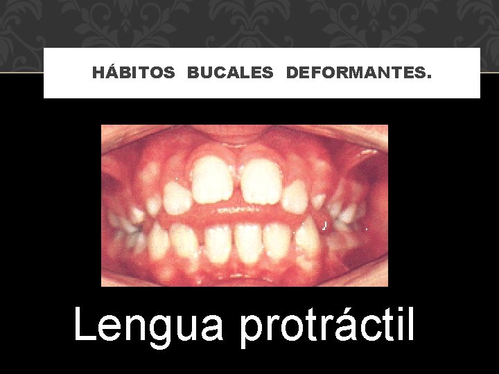 HÁBITOS BUCALES DEFORMANTES. Lengua protráctil 