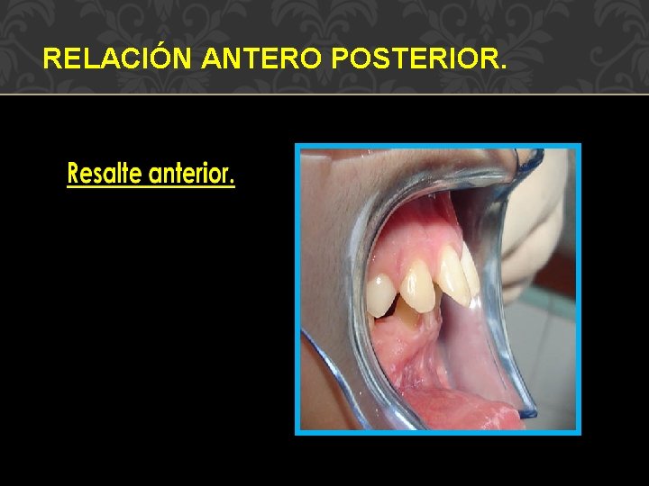 RELACIÓN ANTERO POSTERIOR. 