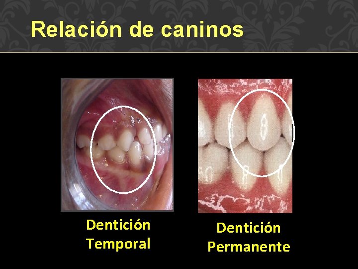 Relación de caninos Dentición Temporal Dentición Permanente 
